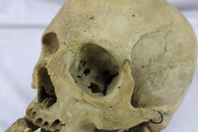 Load image into Gallery viewer, Human Skull with Craniosynostosis
