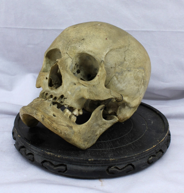 Human Skull with Craniosynostosis